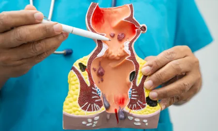 Best Piles, Fissure & Fistula Treatment in Old Sangvi